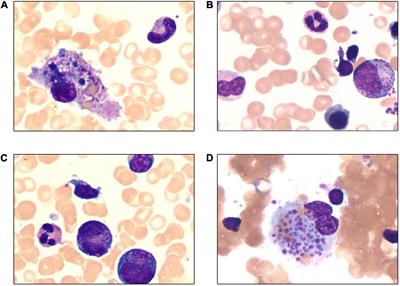 Aggressive Natural Killer Cell Leukemia in an Adolescent Patient: A Case Report and Literature Review